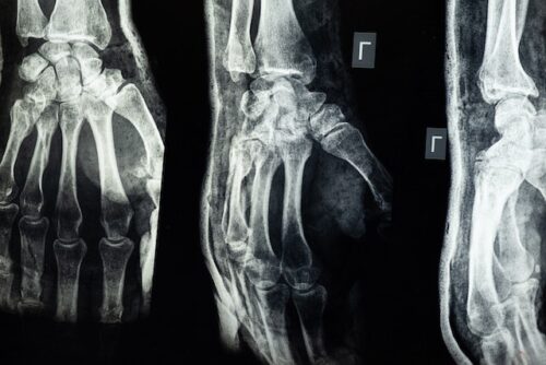 x-ray personal injury
